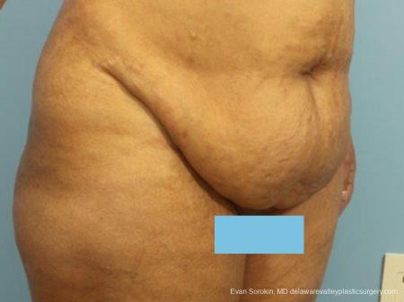 Philadelphia Abdominoplasty 9462 - Before Image 2