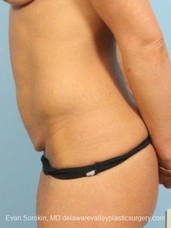 Philadelphia Abdominoplasty 8698 - Before Image 3