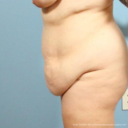 Philadelphia Abdominoplasty 9466 - Before and After Image 4