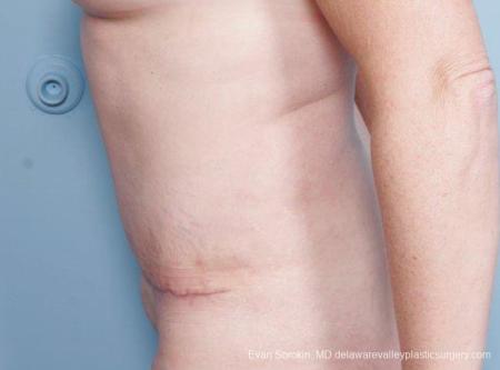 Philadelphia Abdominoplasty 9315 - After Image 3