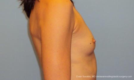 Philadelphia Breast Augmentation 9417 - Before Image 3