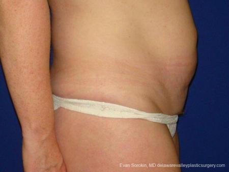 Philadelphia Abdominoplasty 9474 - Before Image 3