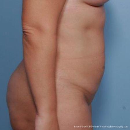 Philadelphia Liposuction 9481 - After Image 3