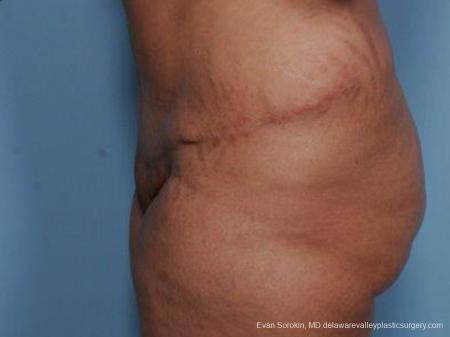 Philadelphia Abdominoplasty 9462 - After Image 5