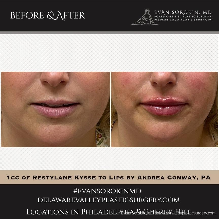 Lip Augmentation: Patient 40 - Before and After 