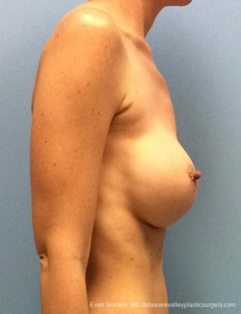 Philadelphia Breast Augmentation 13069 - Before Image 3