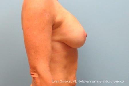 Philadelphia Breast Augmentation 8693 - After Image 4