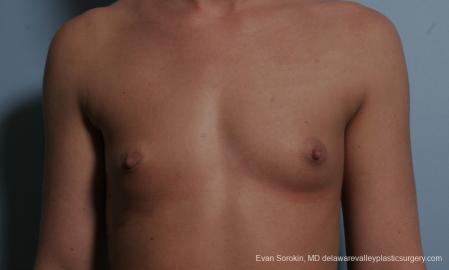 Philadelphia Breast Augmentation 8664 - Before Image 1