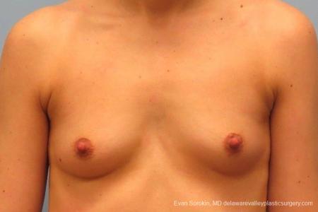 Philadelphia Breast Augmentation 8763 - Before Image 1