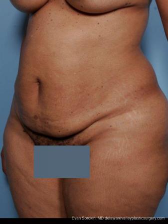 Philadelphia Abdominoplasty 9461 - Before Image 4