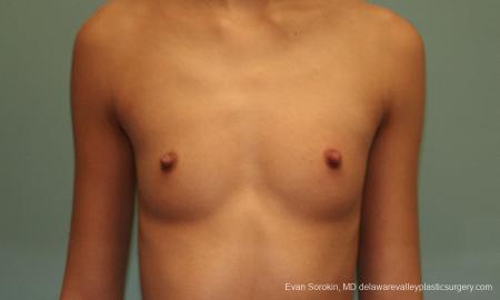 Philadelphia Breast Augmentation 9377 - Before Image 1