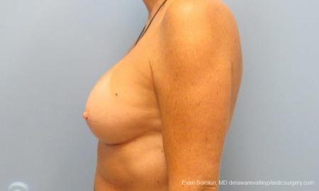 Philadelphia Breast Augmentation 9600 - After Image 5