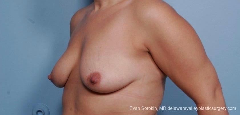Philadelphia Breast Lift and Augmentation 8702 - Before 3