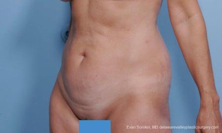 Philadelphia Abdominoplasty 9376 - Before Image 4
