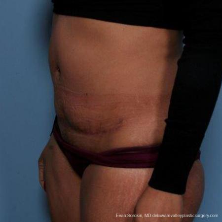 Philadelphia Abdominoplasty 9479 - After Image 4