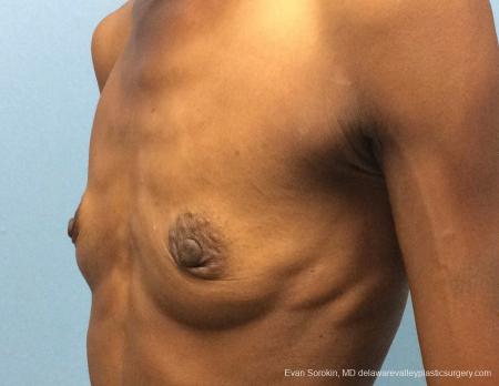 Philadelphia Breast Augmentation 13072 - Before 4