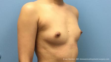 Philadelphia Breast Augmentation 13172 - Before Image 2