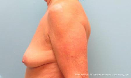 Philadelphia Breast Lift and Augmentation 9598 - Before and After Image 5