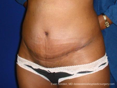 Philadelphia Abdominoplasty 8707 - After Image 2