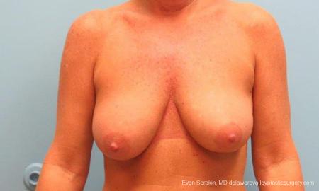 Philadelphia Breast Lift and Augmentation 9398 - Before Image 1