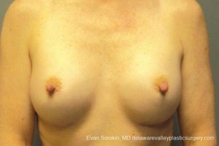 Philadelphia Breast Augmentation 8765 - After Image 1