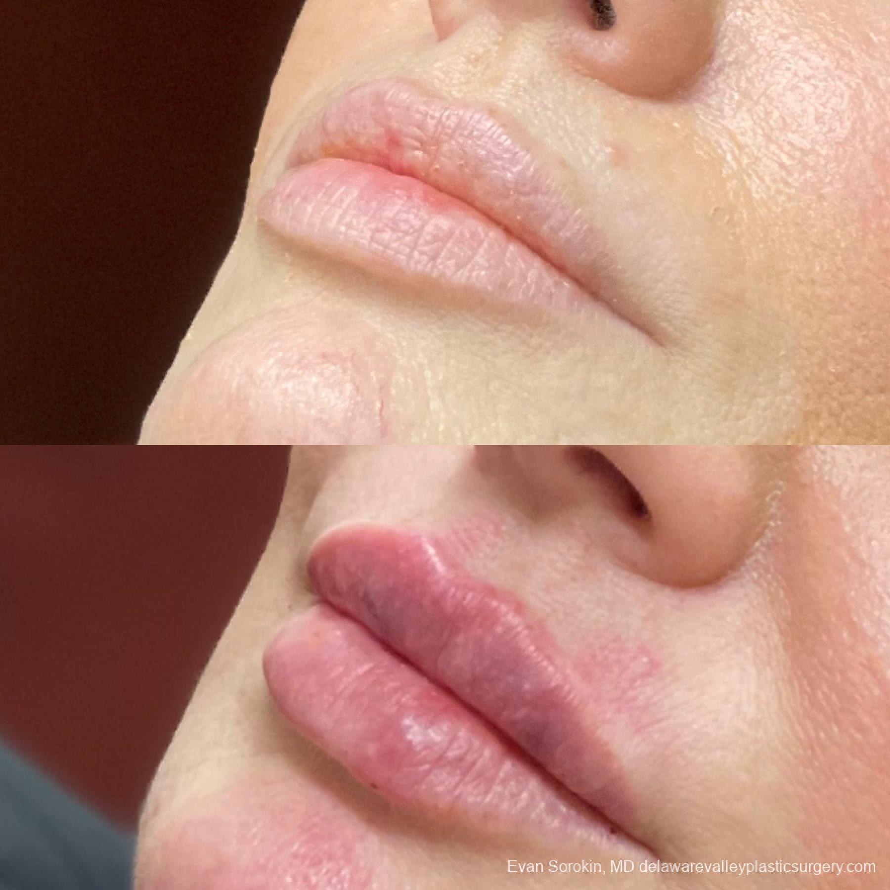 Lip Filler: Patient 40 - Before and After 3