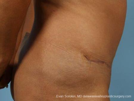 Philadelphia Abdominoplasty 9471 - After Image 3
