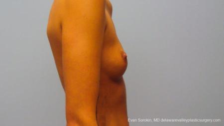 Philadelphia Breast Augmentation 9292 - Before and After Image 5