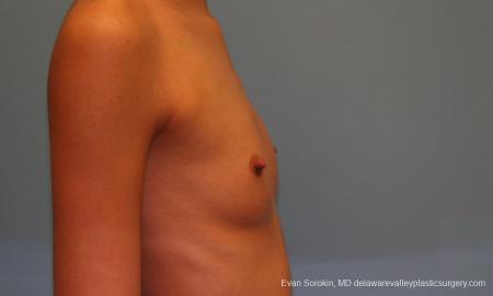 Philadelphia Breast Augmentation 9377 - Before Image 3