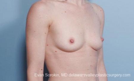 Philadelphia Breast Augmentation 9107 - Before Image 2