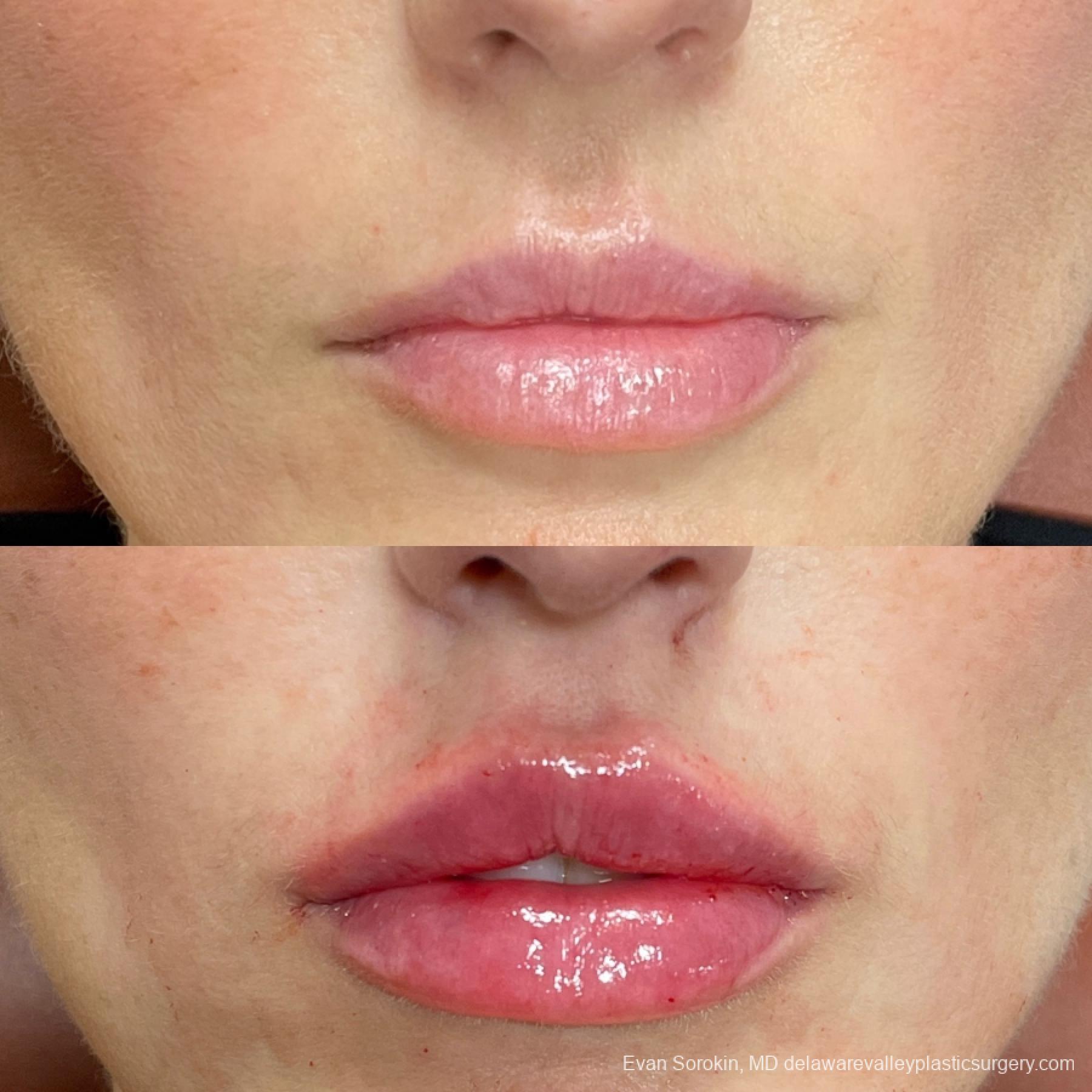 Lip Filler: Patient 2 - Before and After  