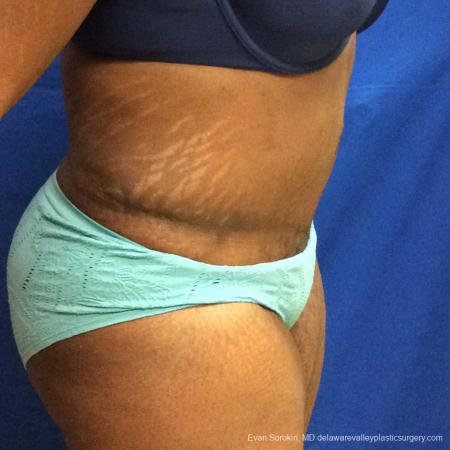 Philadelphia Abdominoplasty 10817 - After Image 3
