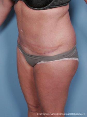 Philadelphia Abdominoplasty 9463 - After Image 4
