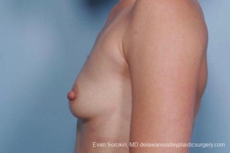 Philadelphia Breast Augmentation 8767 - Before and After Image 5