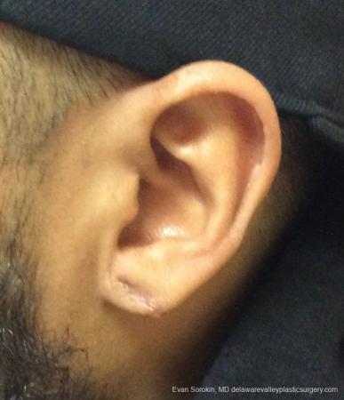 Philadelphia Earlobe Surgery 13181 - After Image 1