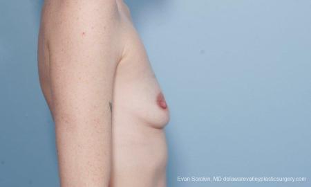 Philadelphia Breast Augmentation 8649 - Before Image 3
