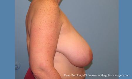Philadelphia Breast Reduction 10118 - Before Image 3