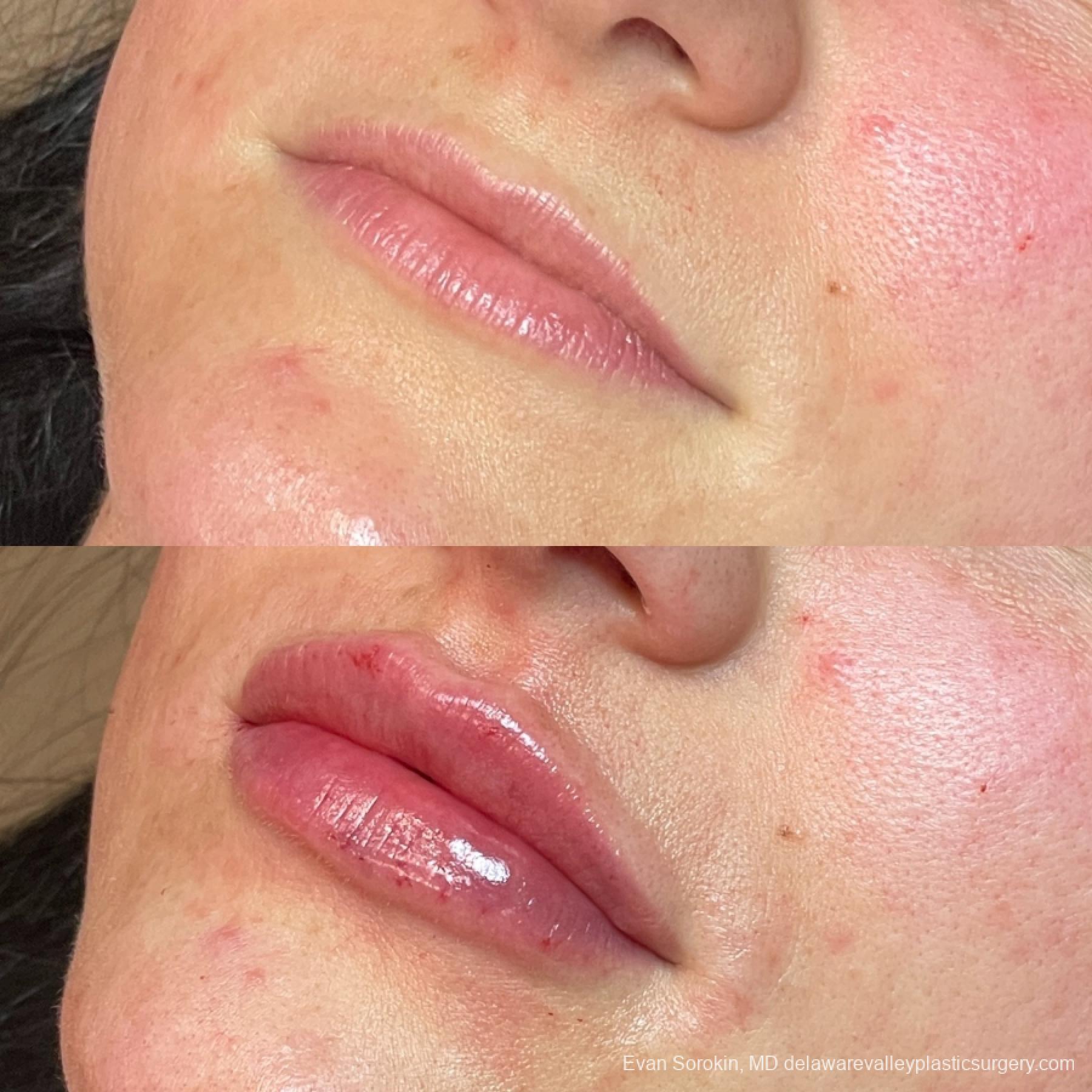 Lip Augmentation: Patient 52 - Before and After 3