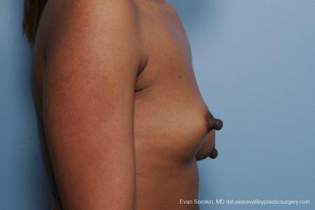Philadelphia Breast Lift and Augmentation 8689 - Before Image 4
