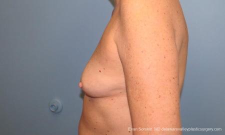 Philadelphia Breast Augmentation 9549 - Before and After Image 5