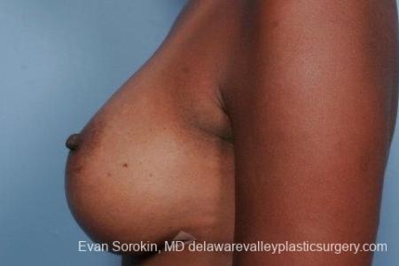 Philadelphia Breast Augmentation 8653 - After Image 4