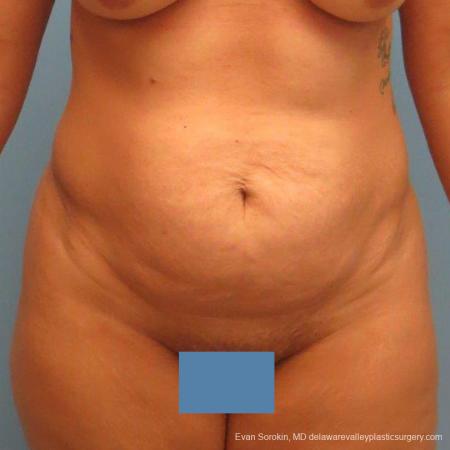 Philadelphia Abdominoplasty 9478 - Before Image 1