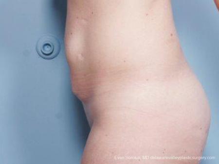 Philadelphia Abdominoplasty 9476 - Before and After Image 5