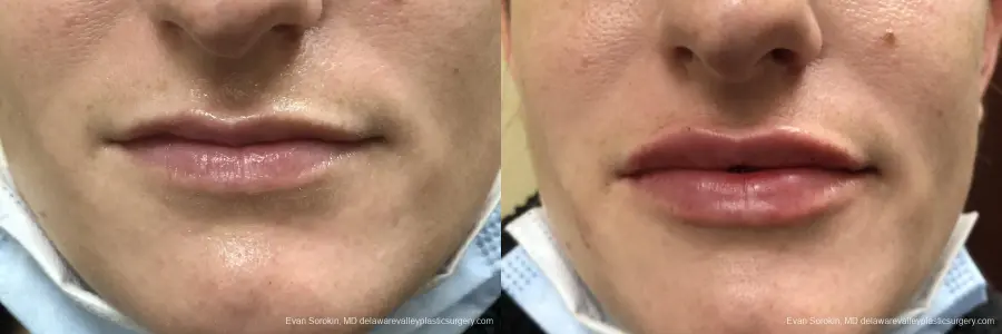 Lip Augmentation: Patient 34 - Before and After 1