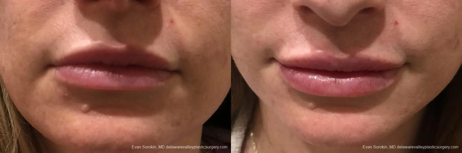 Lip Augmentation: Patient 35 - Before and After 1