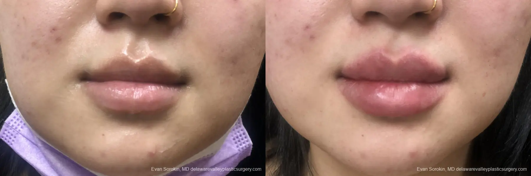 Lip Augmentation: Patient 37 - Before and After  