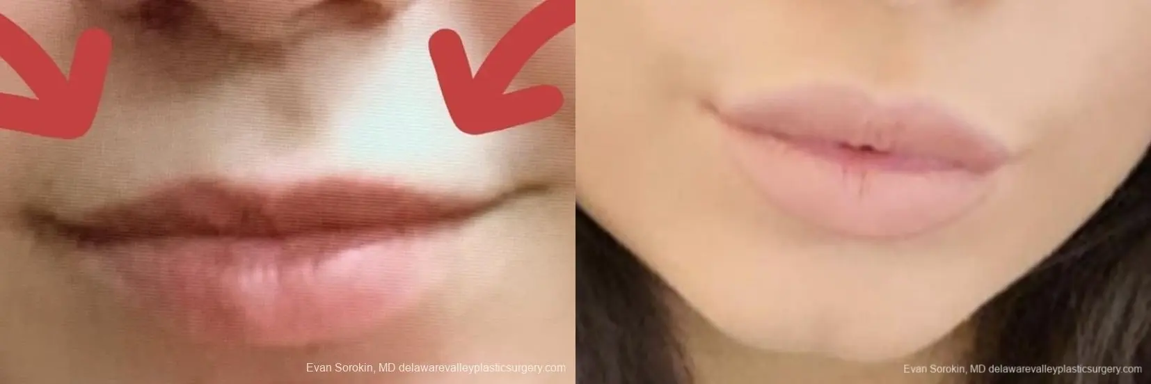 Lip Augmentation: Patient 39 - Before and After  