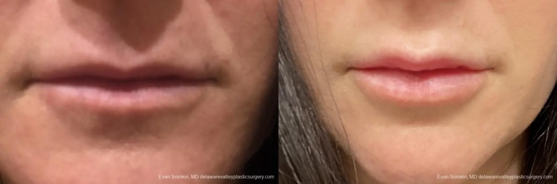 Lip Augmentation: Patient 45 - Before and After 1