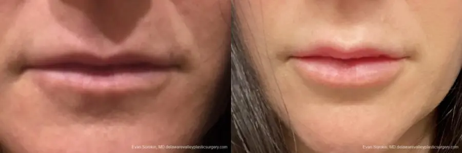 Lip Augmentation: Patient 8 - Before and After 1