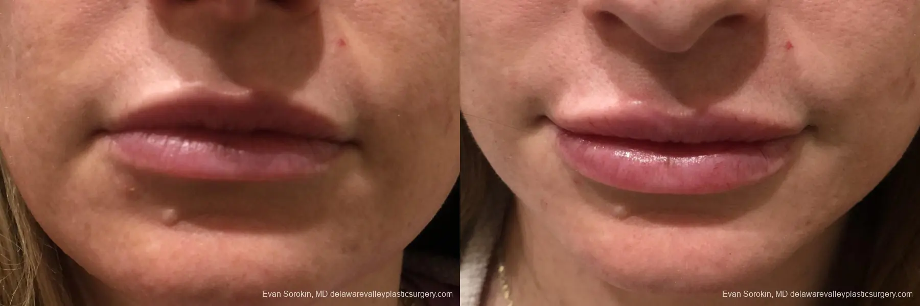 Lip Augmentation: Patient 42 - Before and After 1